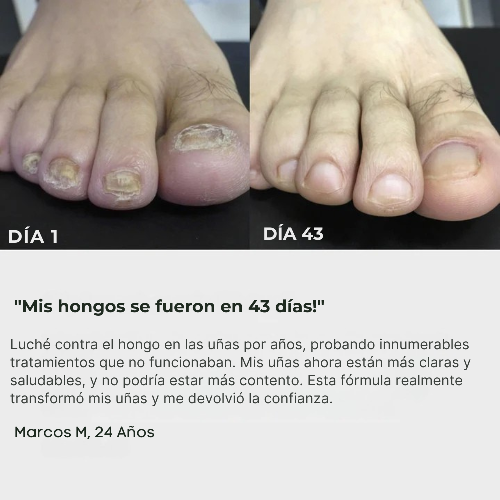 ByeFungus | Elimina los hongos de raíz
